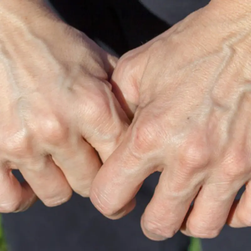 Seeing Prominent, Bulging Veins? Make Sure to Warn Them About These Things