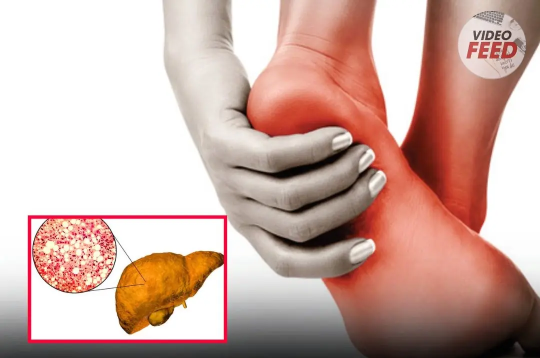 If You Notice This Change in Your Feet, Your Fat:ty Liver May Be Beyond Repair