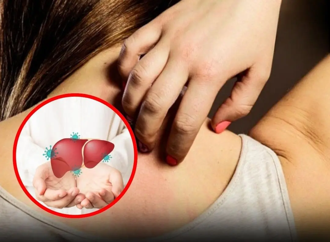 4 Skin Symptoms That Could Be Warning Signs of Liver Disease 👇