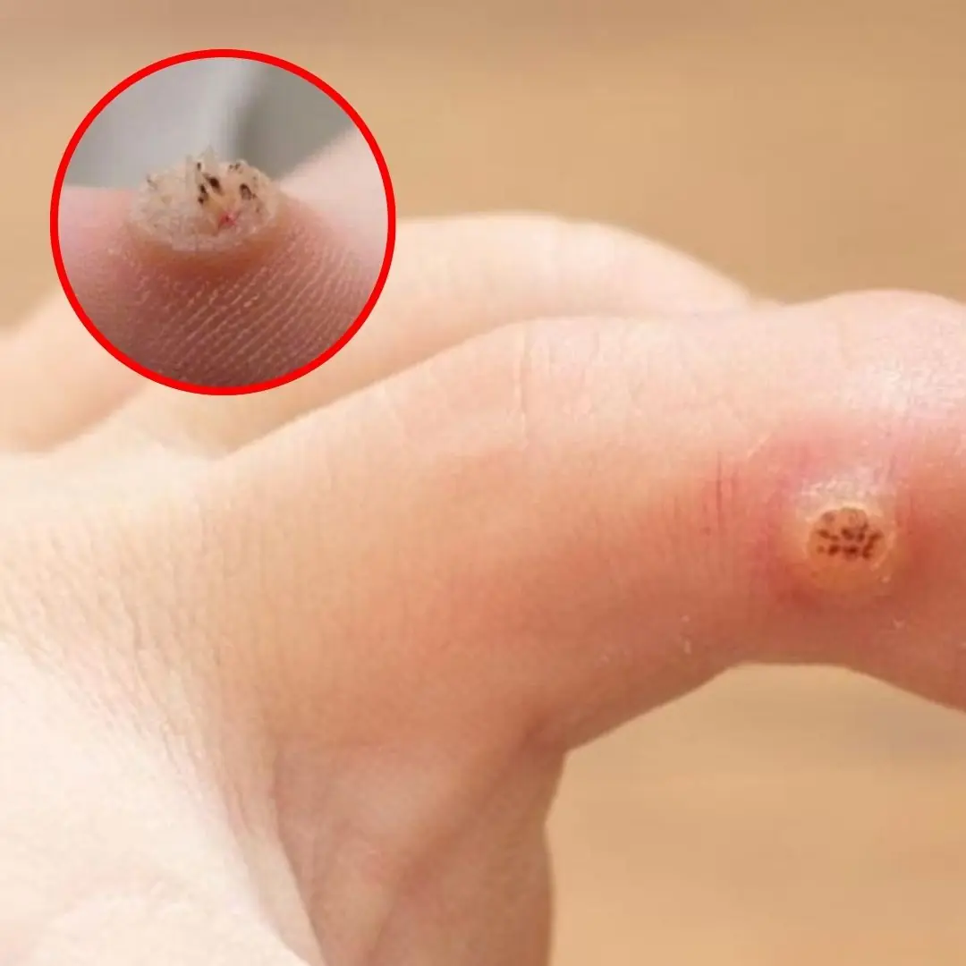6 Types of Warts (Signs, Symptoms, Home Remedies, and Treatment)