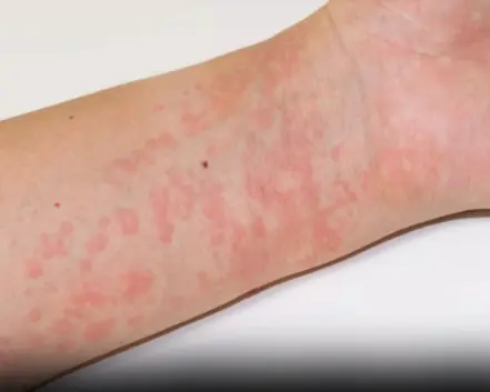 Surprising Causes Of Hives Revealed — What May Be Triggering Your Skin Reaction