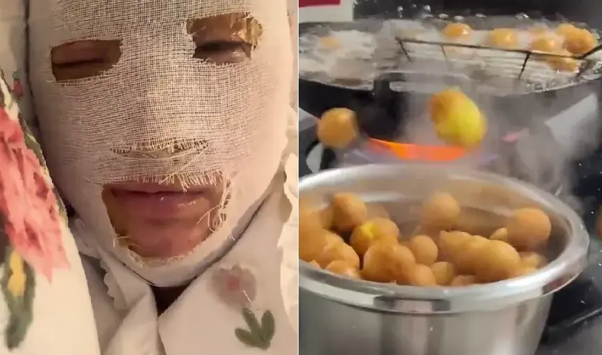 A young woman nearly had her face disfigured while cooking, warning about 3 foods that can easily “expl.ode” and require caution