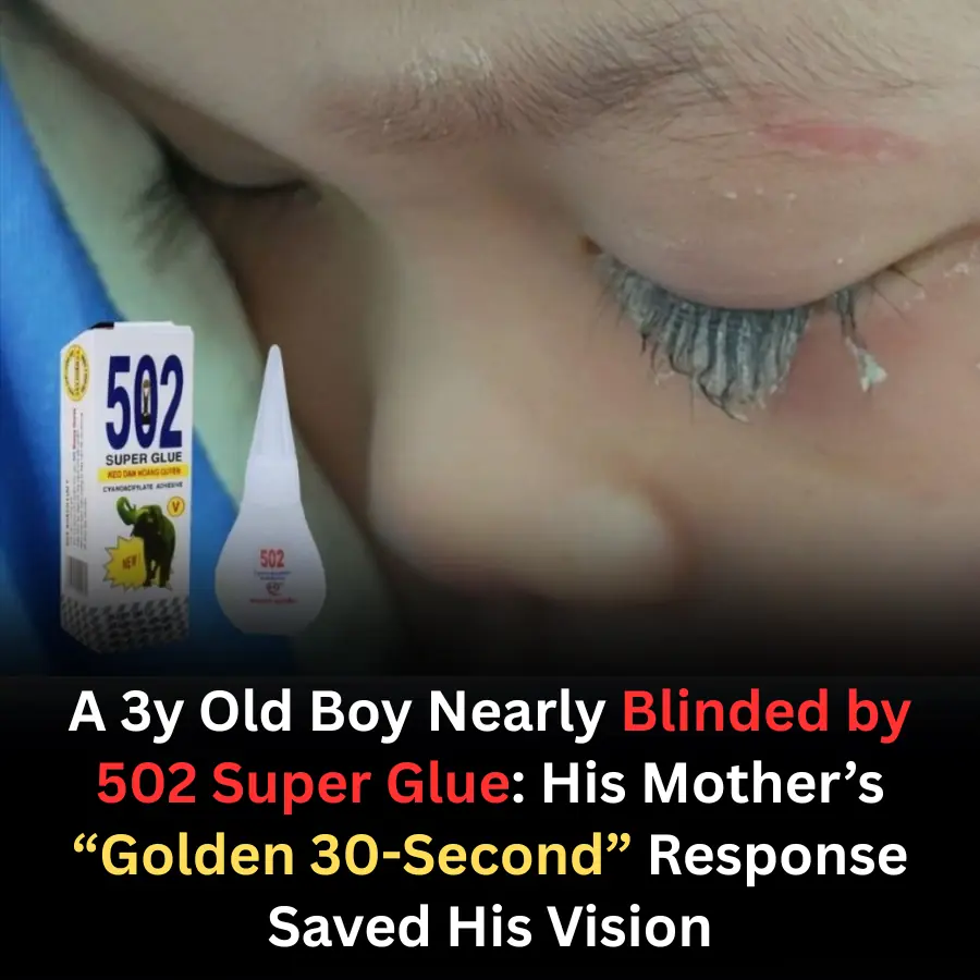 A 3-Year-Old Boy Nearly Blinded by 502 Super Glue