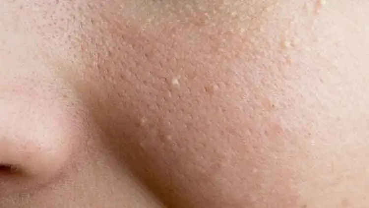 Tiny White Pimples on Your Face? Here’s What Causes Them—and How to Get Rid of Them