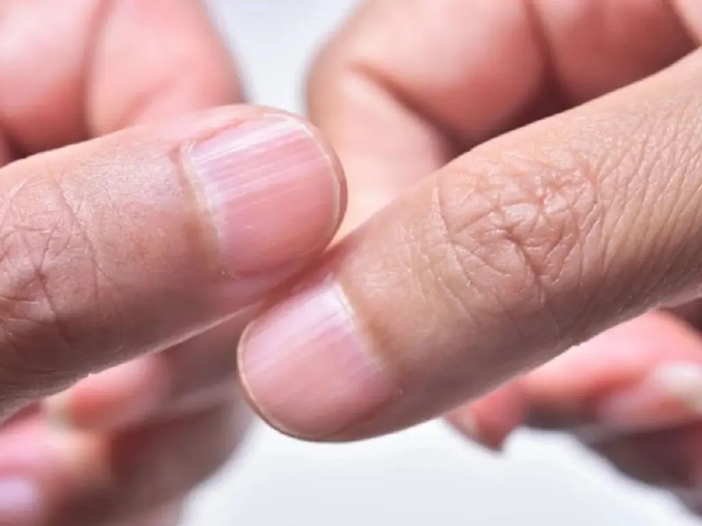 Lines on your nails could be a hidden health warning: What your body may be telling you?