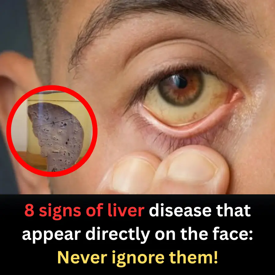 8 Facial Signs That May Signal Liver Disease — Doctors Urge the Public Not to Ignore Them