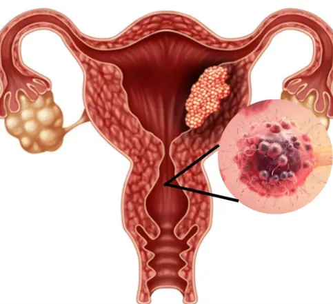 5 early warning signs of cervical cancer