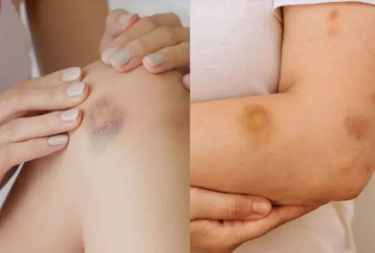 If You Get These Bruises on Your Body… Here’s What It Means