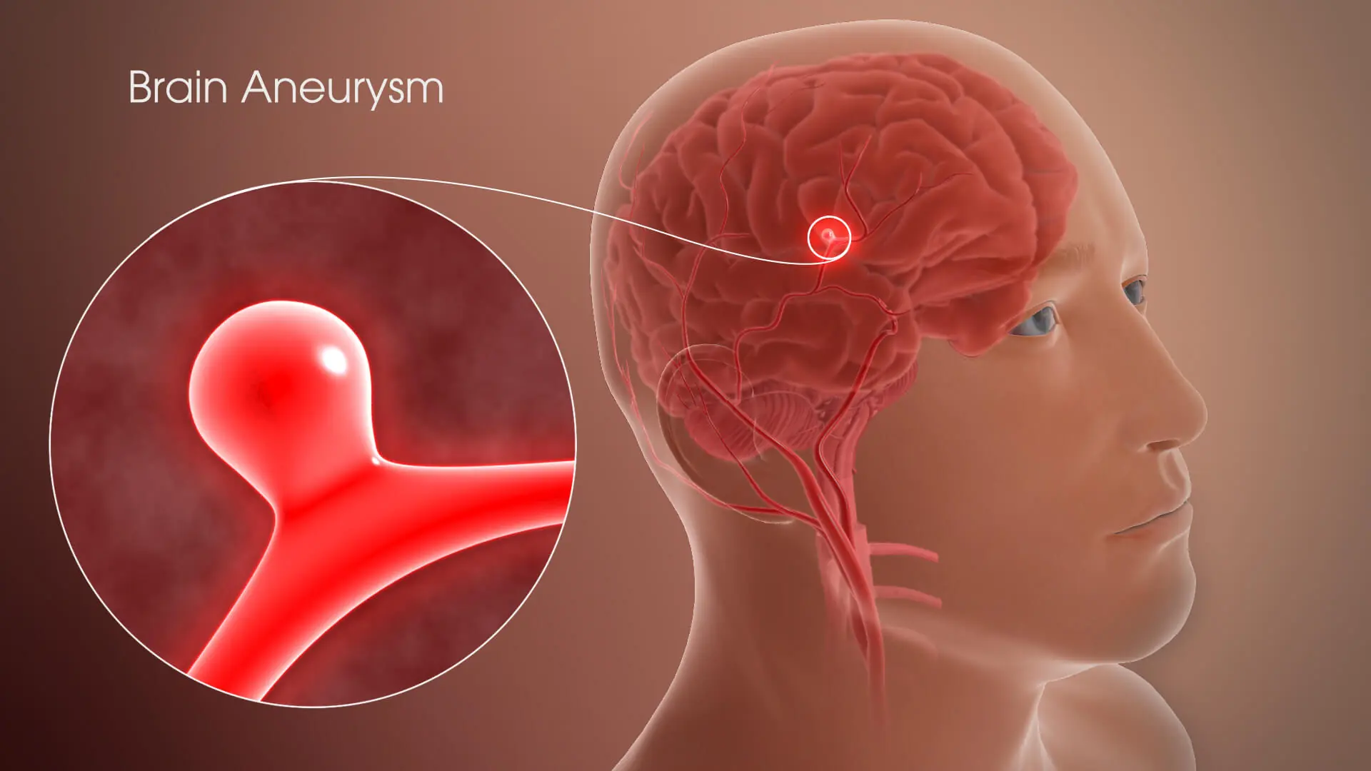 Many People Miss These 12 Brain Aneurysm Signs — Don’t Let It Happen to You