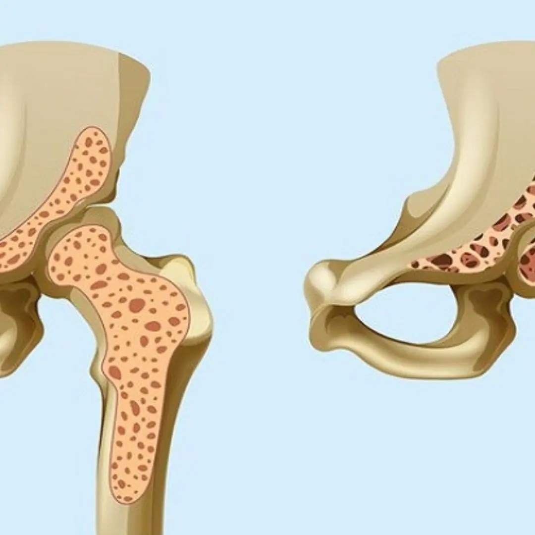Drinking These Too Often Can Quietly Weaken Your Bones — 3 Hidden Calcium Thieves