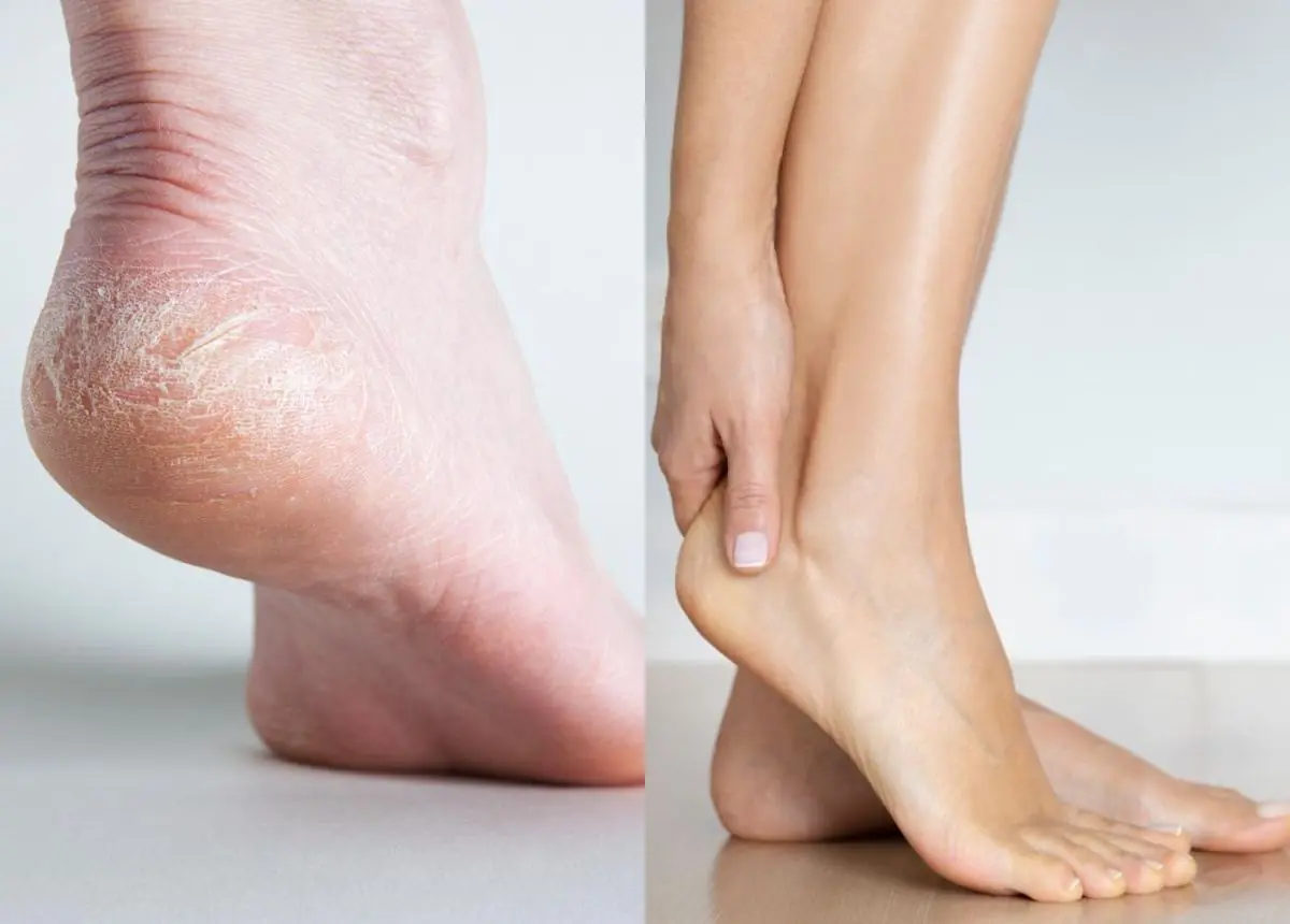 Cracked heels are not always caused by dry skin: Be aware of these conditions