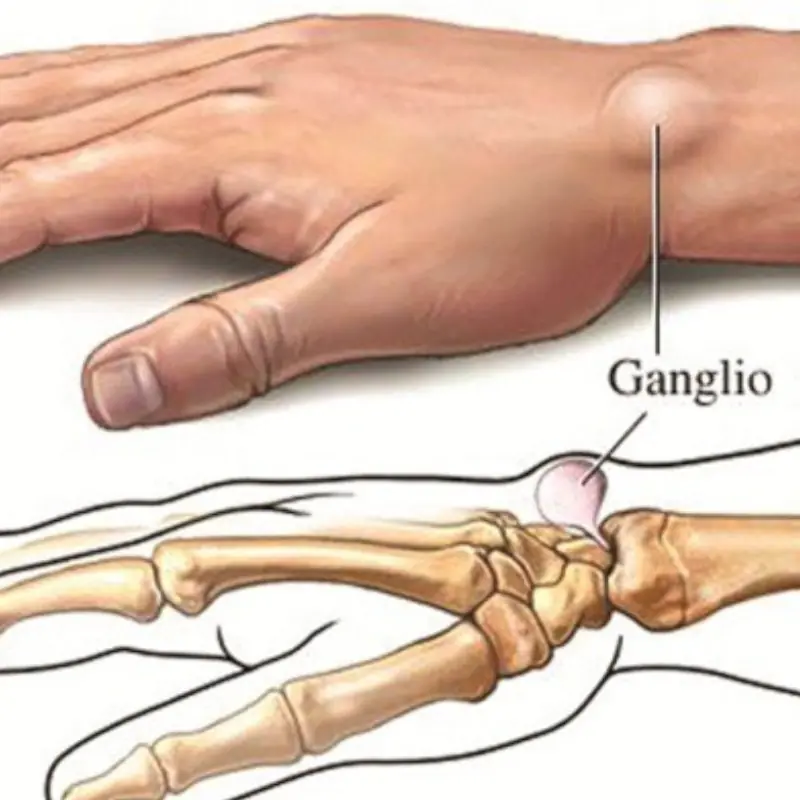 Notice This Lump on Your Wrist? It May Be Caused by a Daily Habit