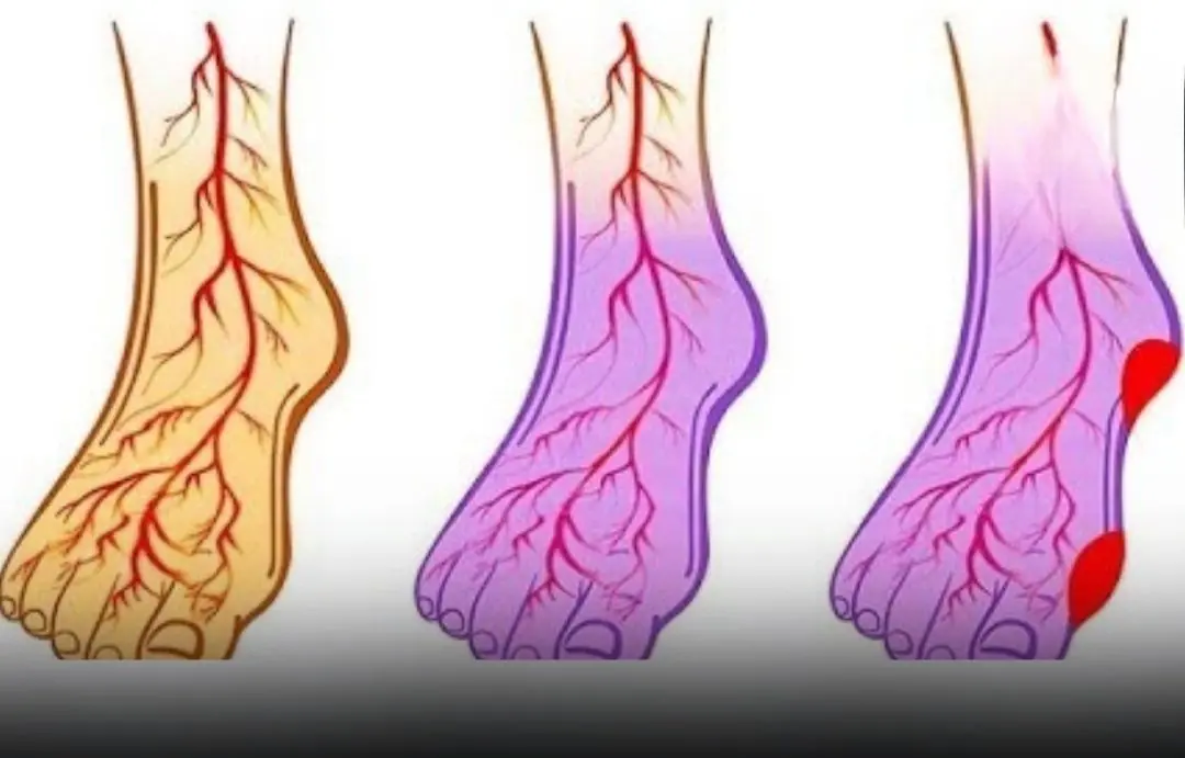 Struggling With Blood Pressure or Vein Problems? Try These 5 Life-Saving Habits Now!