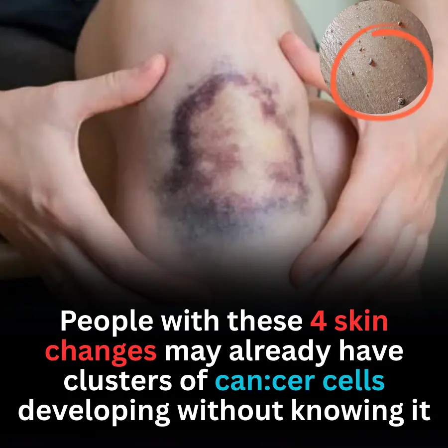 People with these 4 skin changes may already have clusters of can:cer cells developing without knowing it