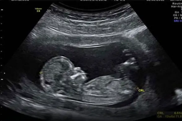 Scientists May Have Actually Found One Of The Causes Of Autism