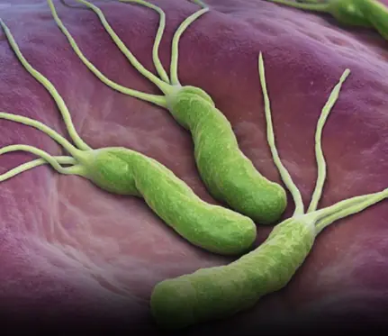 How to Treat H. Pylori (Helicobacter Pylori) Naturally Without Antibiotics
