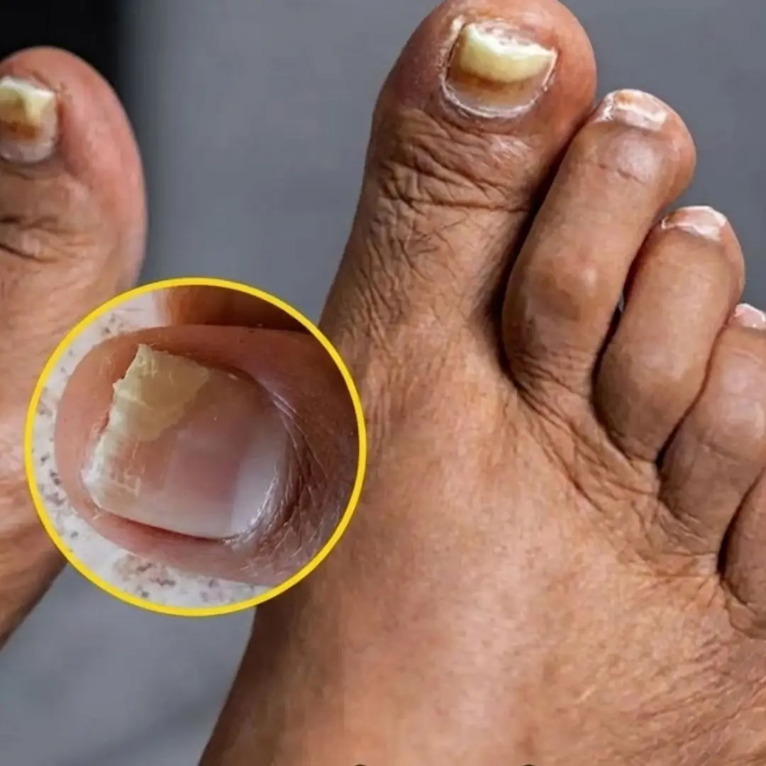 Health Expert Reveals Warning Signs of Two Silent Foot Killers and How To Spot Them