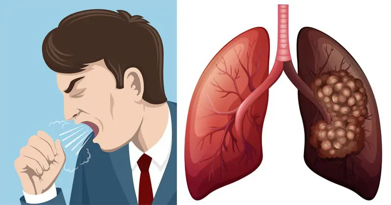 Persistent Cough, Lingering Flu Symptoms: Warning Signs of Lung Can.cer Often Mistaken for “Minor ill.nesses”