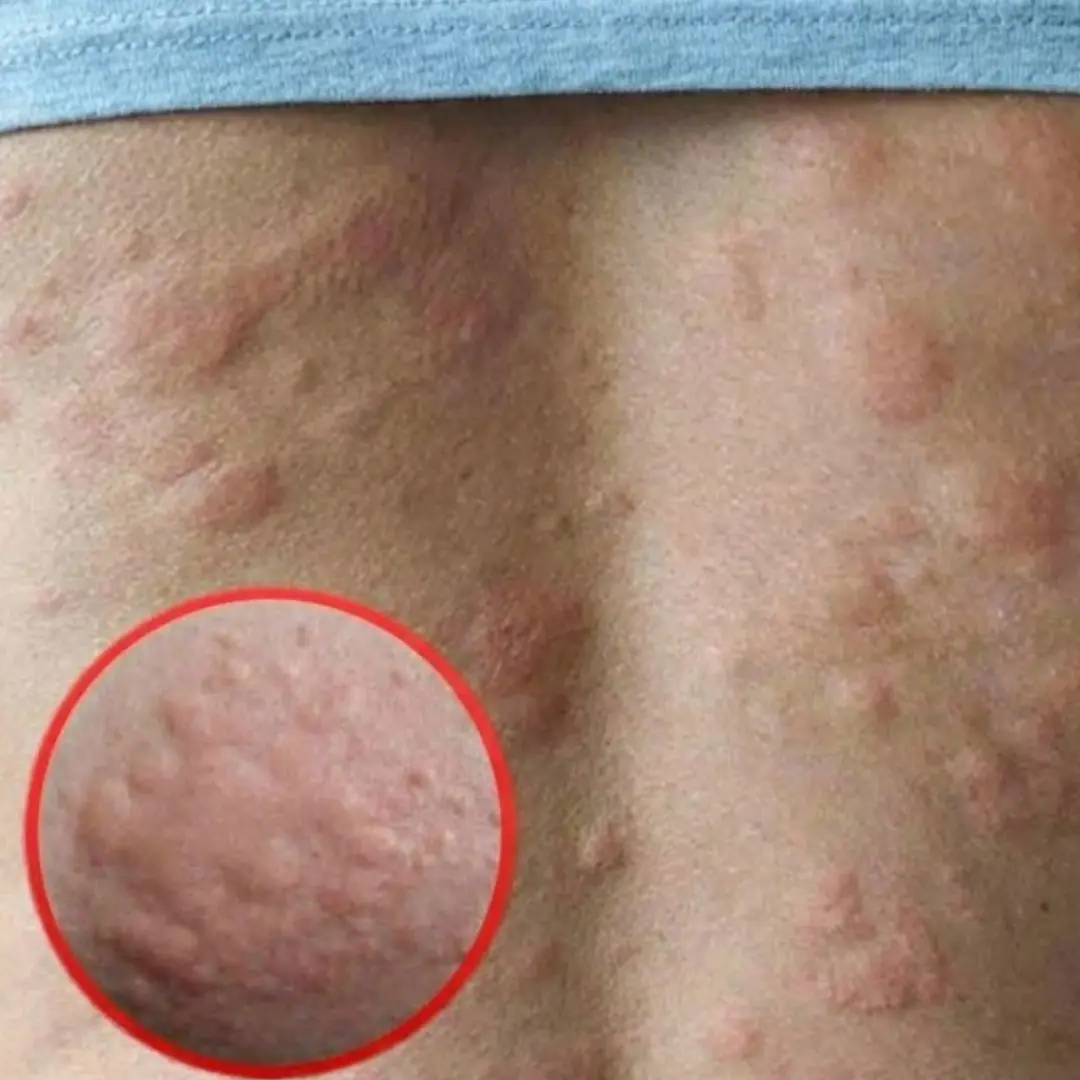 His whole body was itchy, he thought it was an allergy. But he was diagnosed with