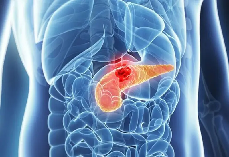 Pan.creatic can.cer: 10 early warning signs you should never ignore