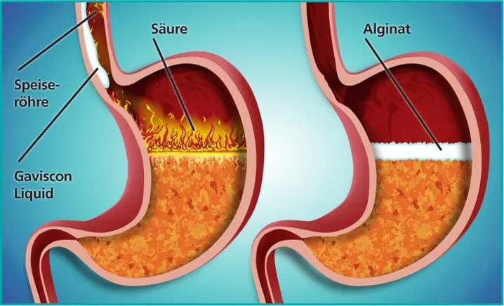 8 Red Flags That Your Stomach Problem May Be Advanced — See a Doctor Early