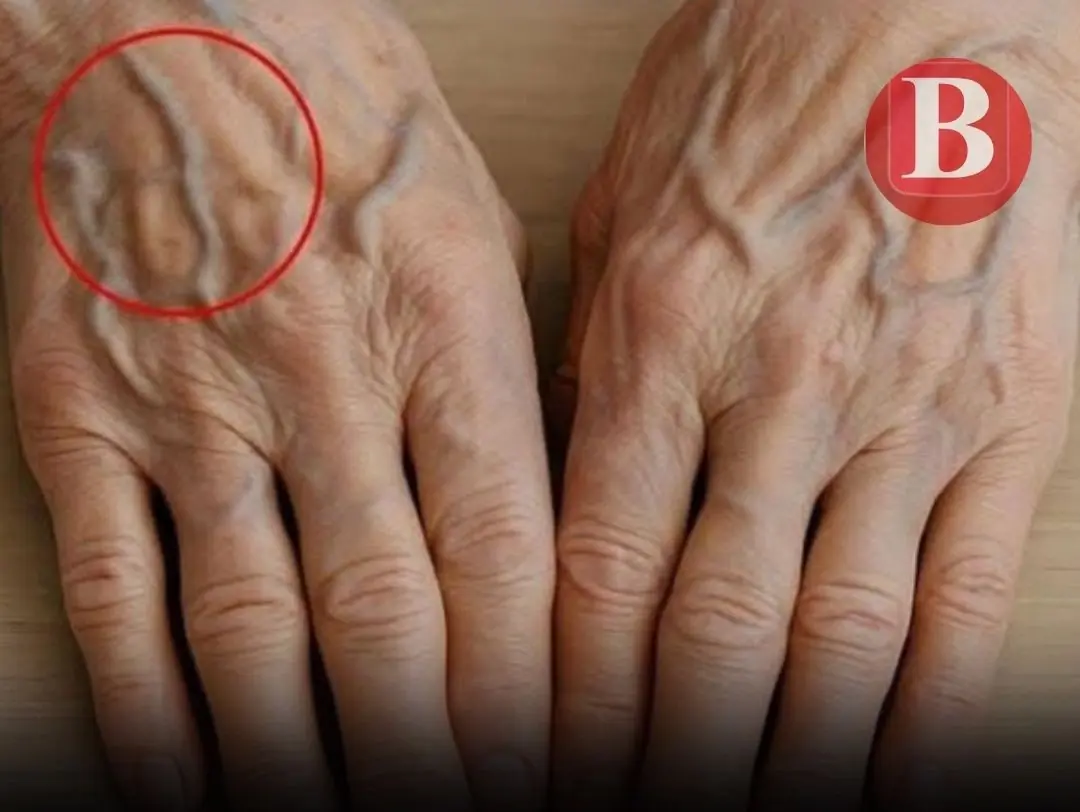 If You See Someone With Bulging Veins, Warn Them About This Immediately!