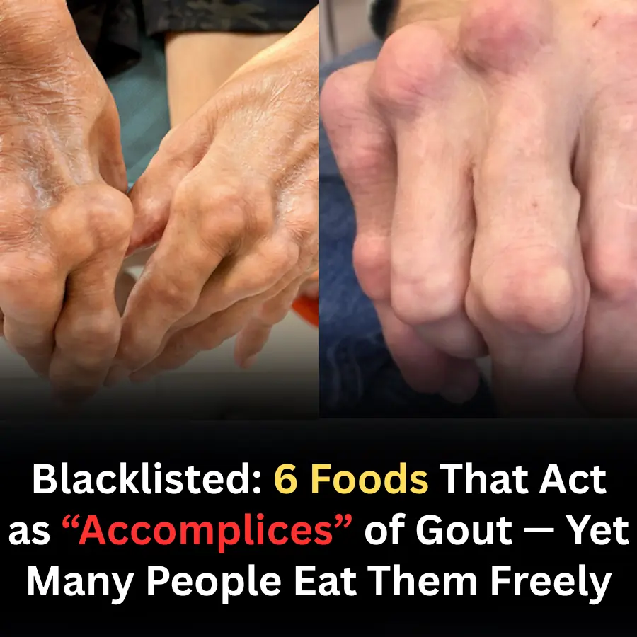 6 Foods That Worsen Gout Without You Realizing It — Doctors Urge Caution