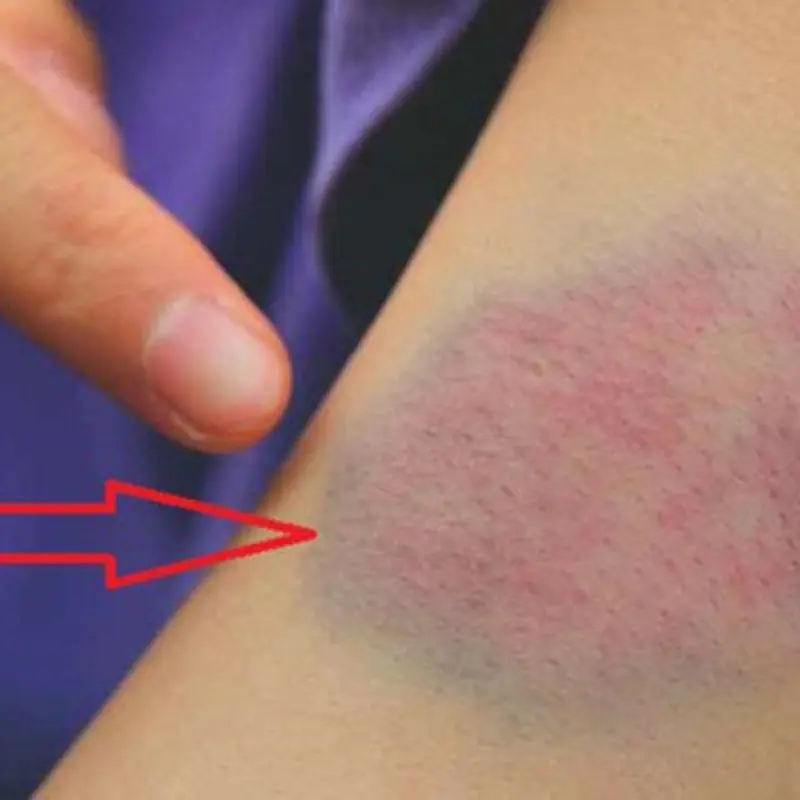 Doctors Explain What These Bruises on Your Body Might Mean