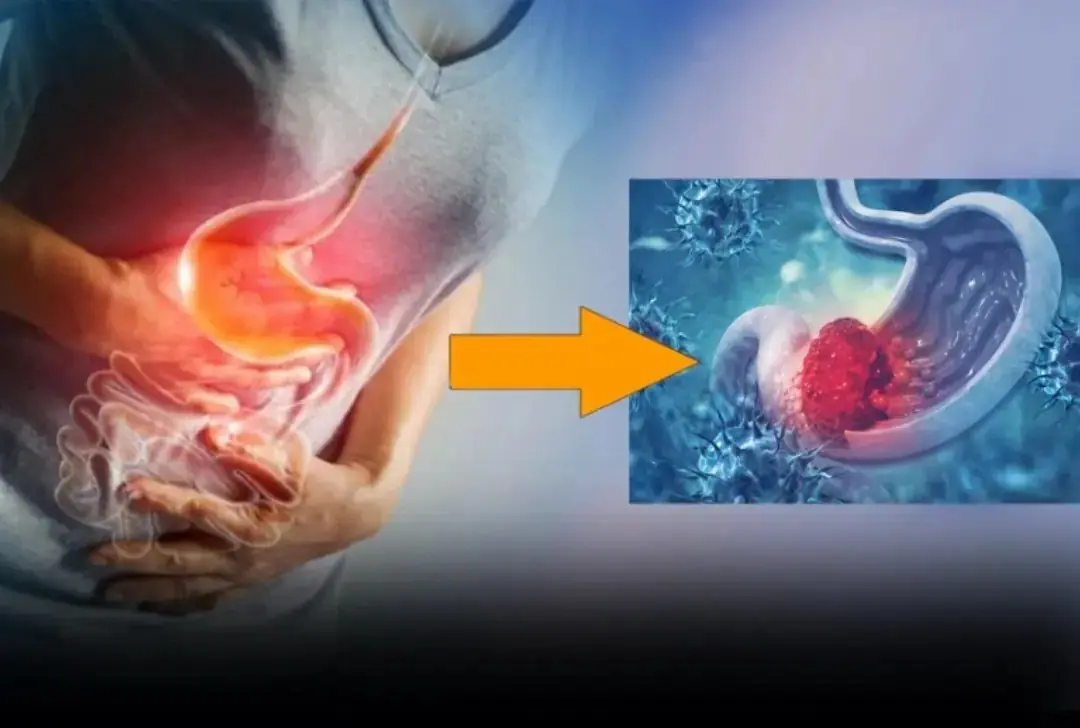 Sto.mach can.cer is a disease that takes the lives of many people around the world.