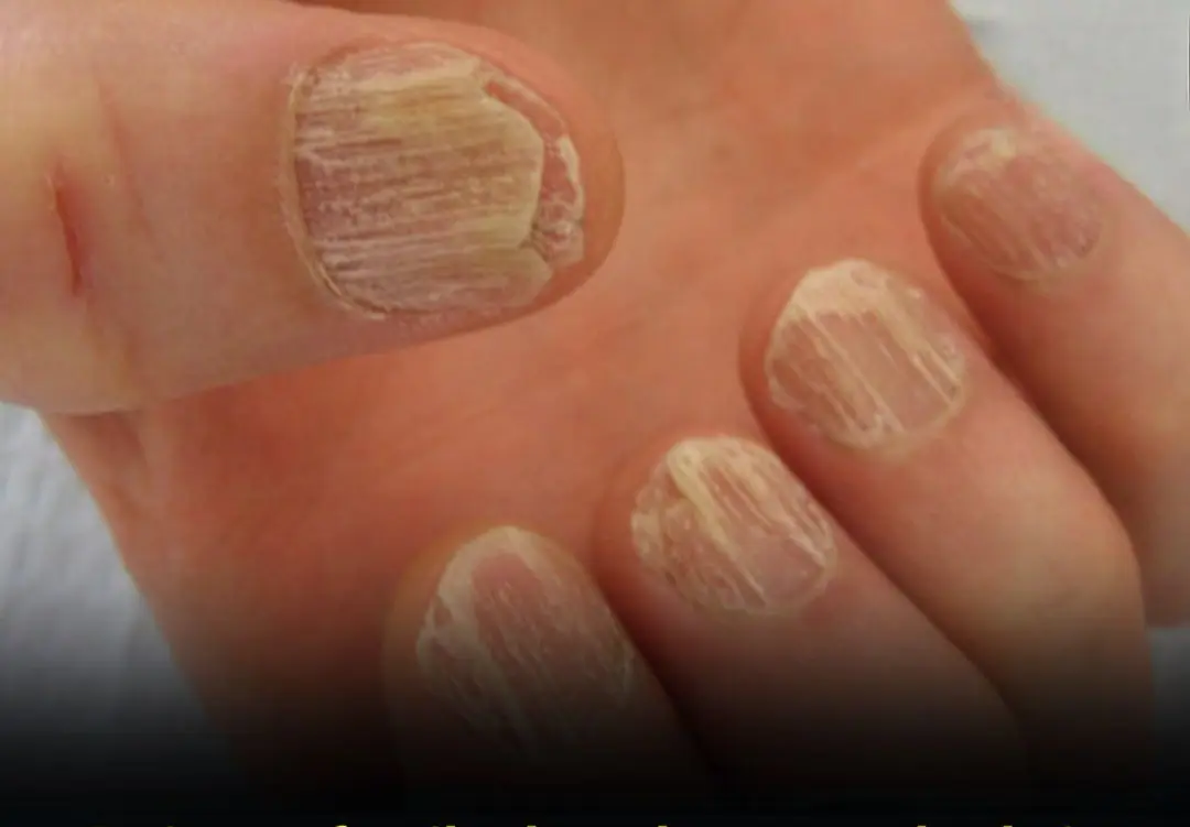 9 Alarming Nail Changes That Reveal Hidden Health Problems