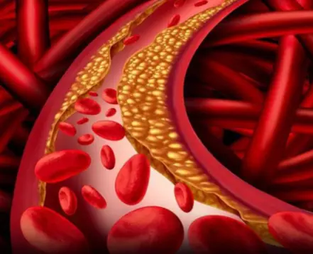 36-Year-Old Teacher Passes Away from Diabetes Despite Not Liking Sweets — Doctor Says It's Due to 4 Favorite Foods