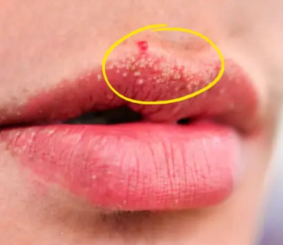Why You Might See Unusual White Bumps On Your Lips Or Genitals