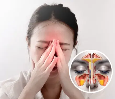 8 Natural Remedies for Sinus Infections That Work Without Antibiotics