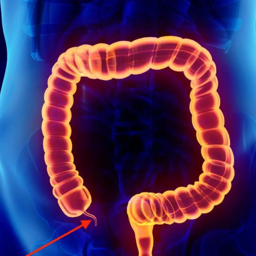 5 Signs of Appendicitis — Don’t Ignore These Symptoms!