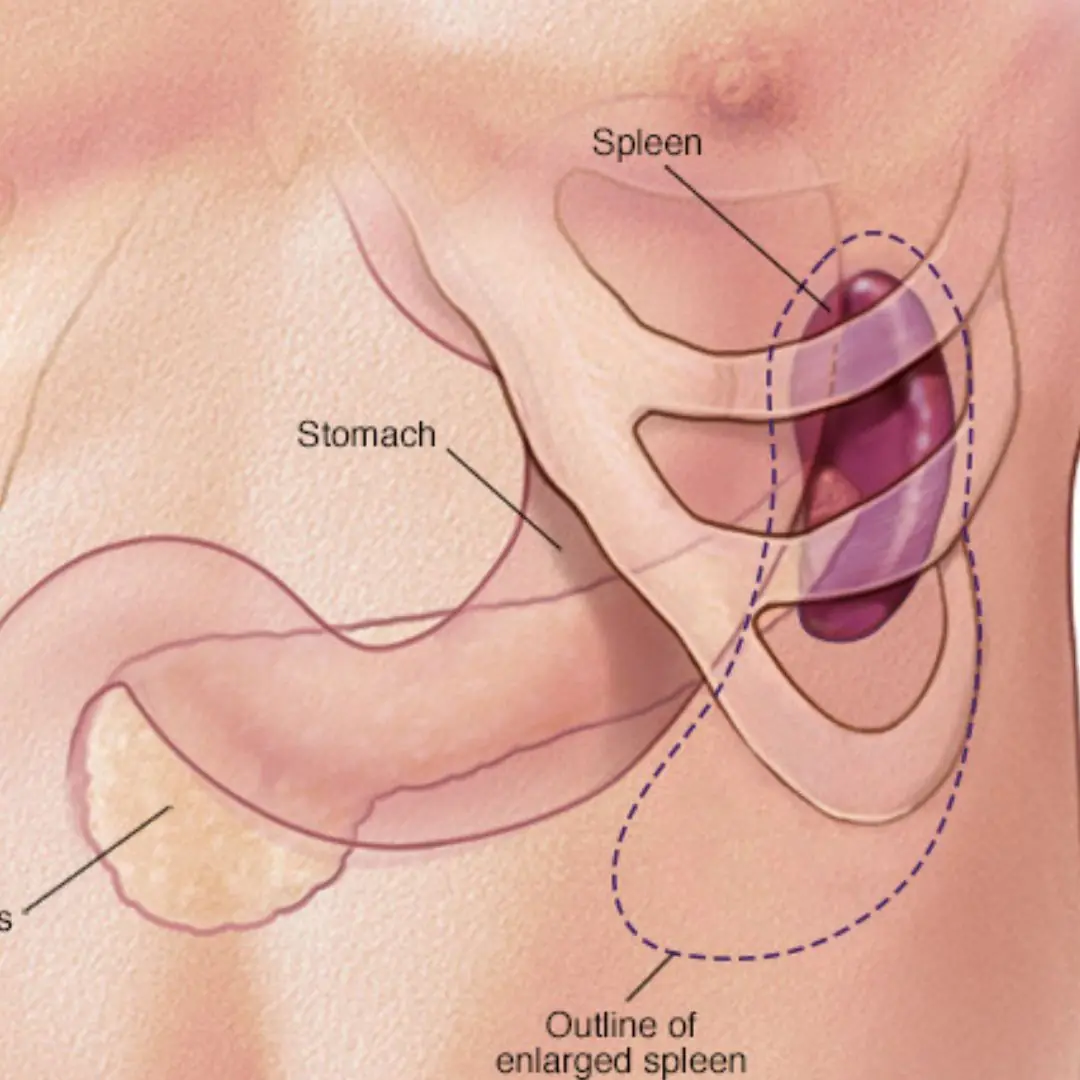 Is Your Spleen Trying to Tell You Something? Watch for These Symptoms