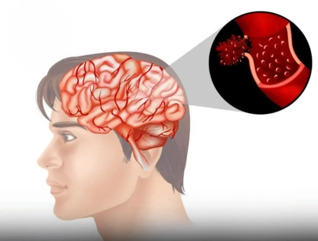 4 Morning Mistakes That Increase Str.oke Ris.k