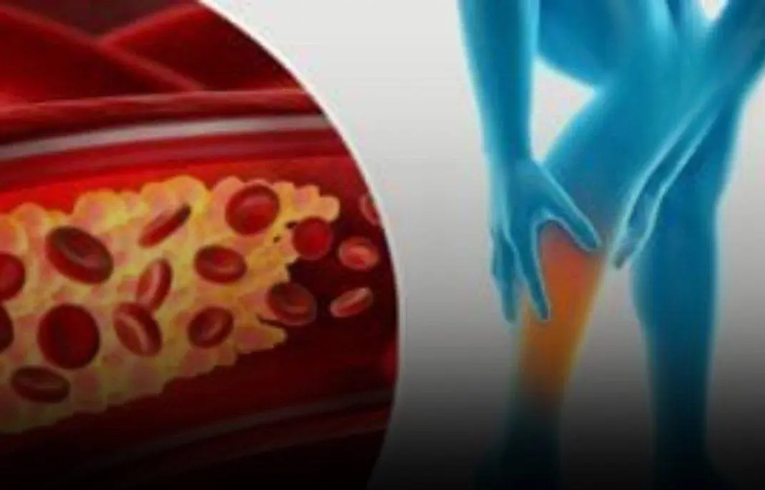 Your feet could be signaling that your arteries are clogged.