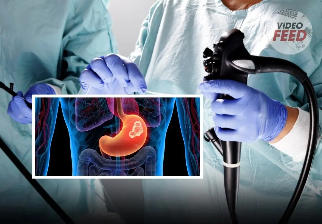 Most cases of stomach can:cer are detected too late.