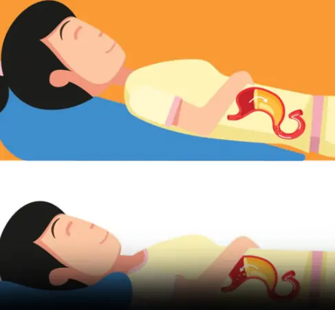 3 Ways to Stop Acid Reflux Naturally