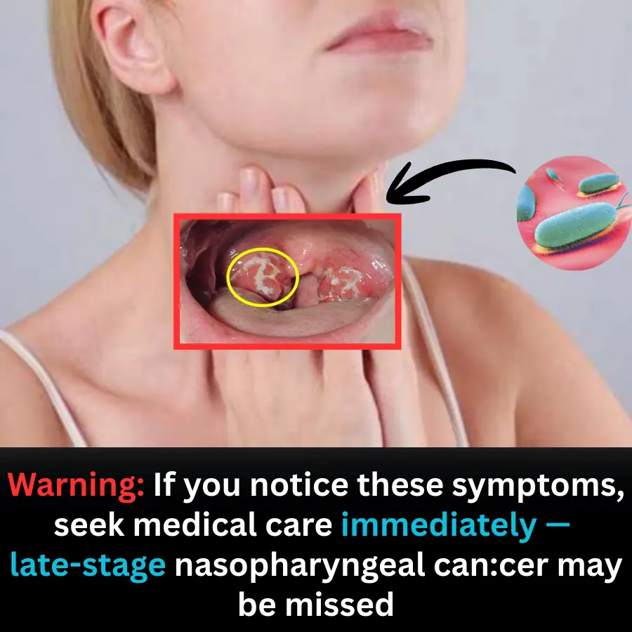 Doctors Warn: Certain Symptoms Require Immediate Medical Attention to Rule Out Advanced Nasopharyngeal Cancer
