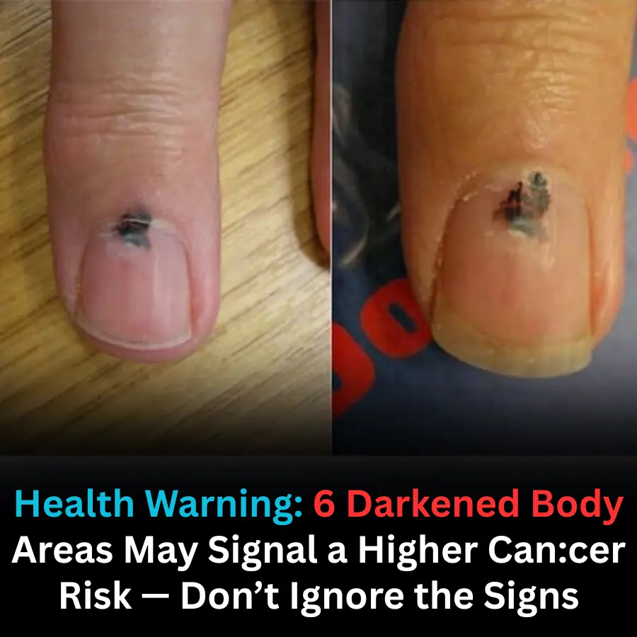 Health Alert: Darkening in Certain Body Areas May Indicate Underlying Can.cer Risk