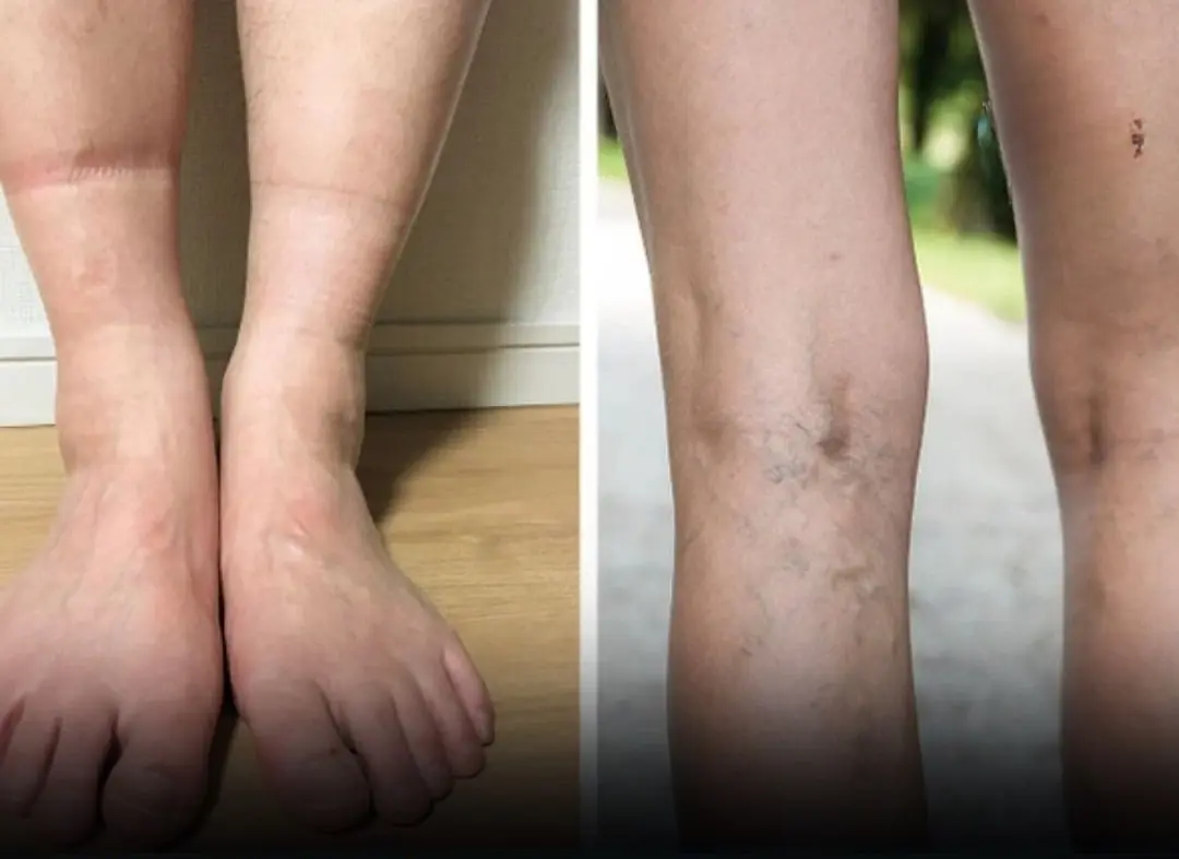 4 Possible Health Conditions Your Feet Could Be Signaling Through Sock Indentations