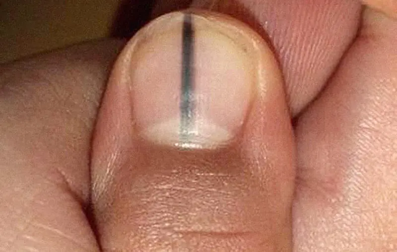 Your Fingernails May Be Warning You: 9 Signs to Watch For