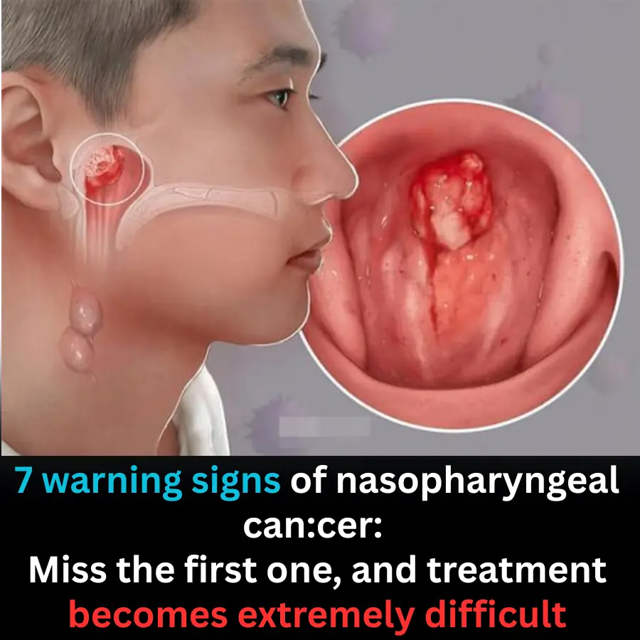 7 warning signs of nasopharyngeal can.cer: Miss the first one, and treatment becomes extremely difficult.