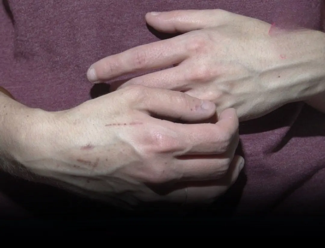 If you notice someone with prominent veins, make sure they hear this advice