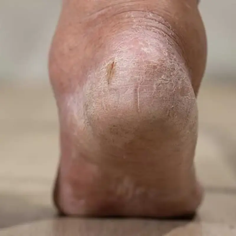 These 5 Changes in Your Feet Might Be Linked to Kid.ney Health Issues