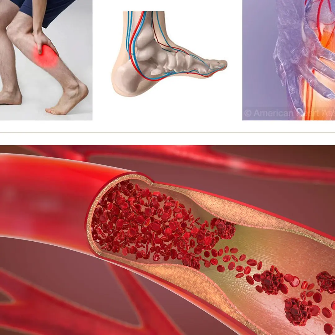 Not many people know the warning signs of a heart blockage that appear in your feet and legs at night