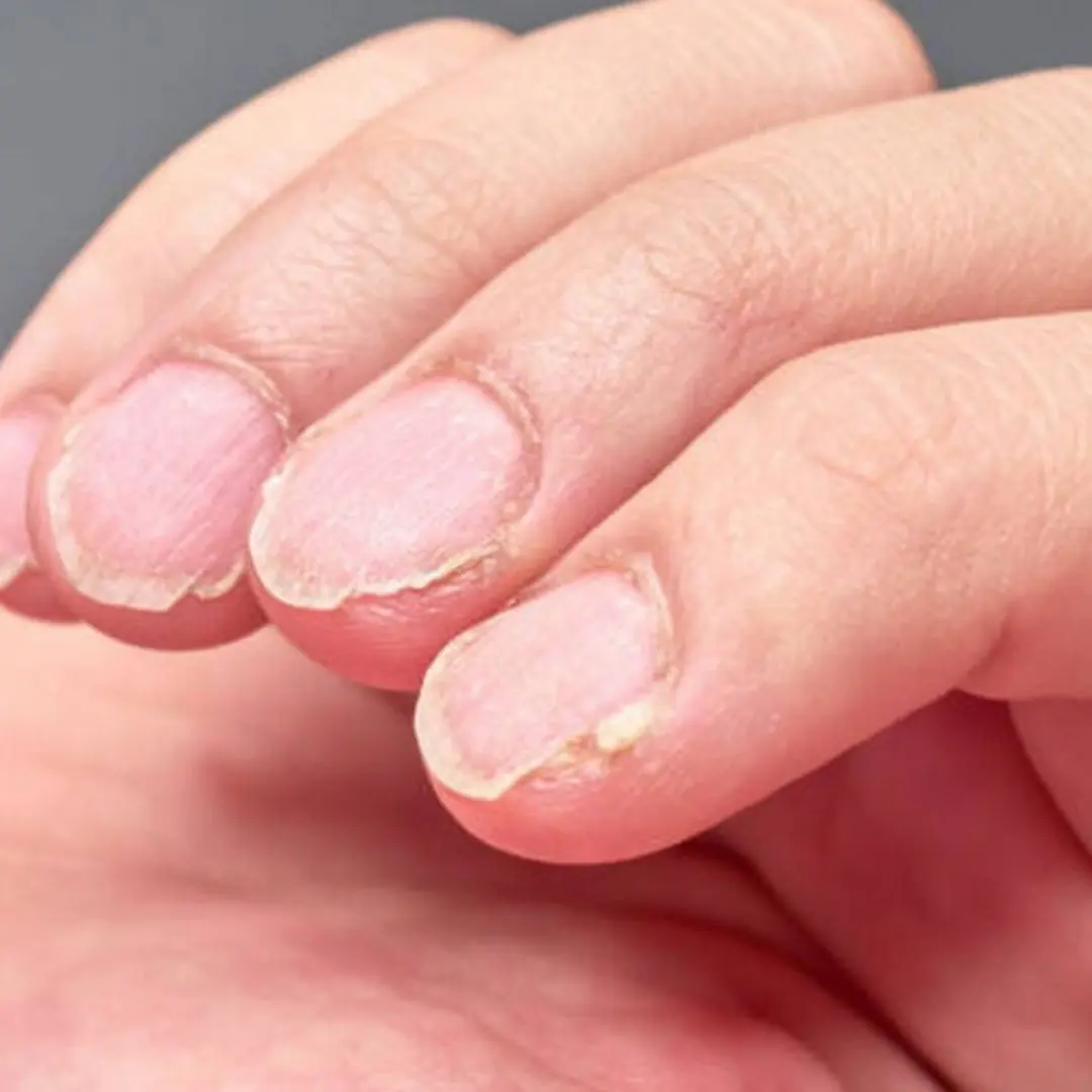 5 signs of iron deficiency that you need to recognize early