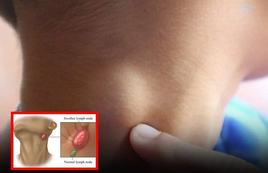 Ne.ck Swe.lling and Lymph No.des: Know When It’s Time to Act