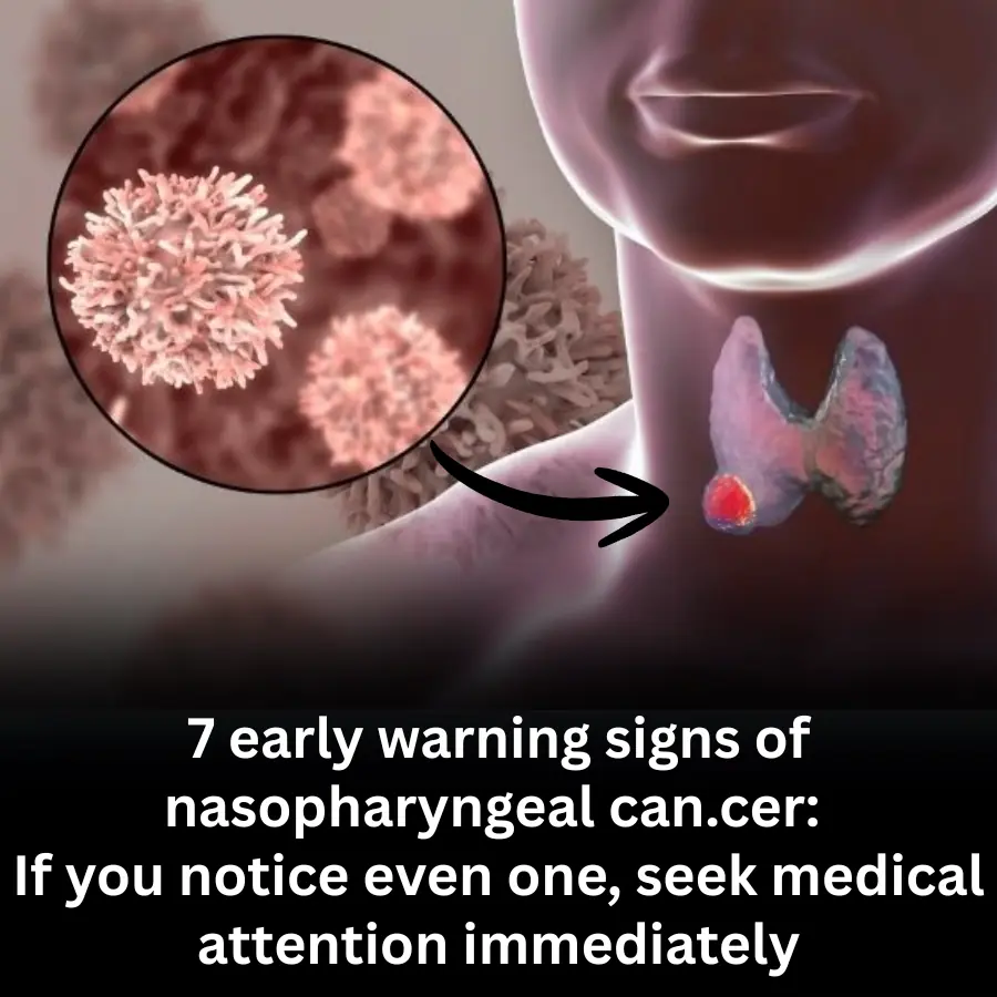 7 Early Signs of Nasopharyngeal Can.cer You Should Never Ignore